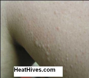 Cholinergic Urticaria Cure | How I Cured My Chronic Hives